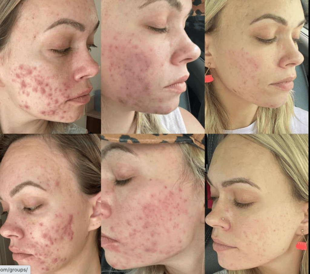 results after using Collagen